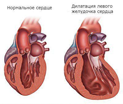 Дилатация камер сердца что это такое - Все про гипертонию