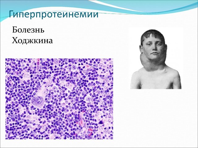 Общий белок в крови повышен – причины, симптомы и лечение патологии