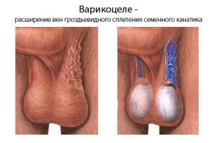 Варикоз на мошонке на сайте варикоз