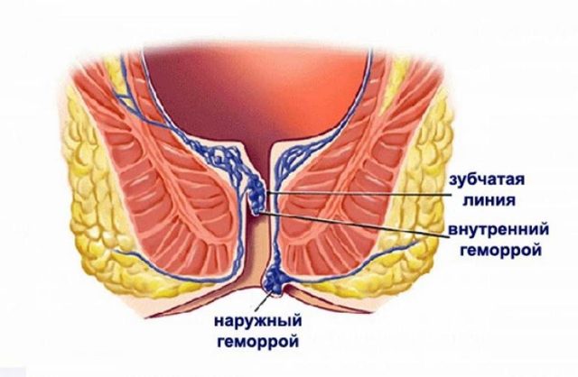 Хронический геморрой – лечение хронического геморроя, симптомы и признаки