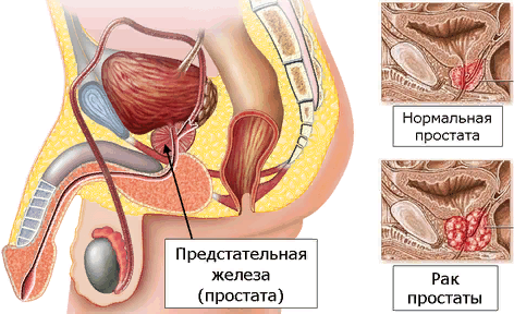 Анализ крови ПСА — что это такое? Расшифровка и норма