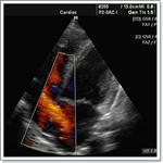 Шумы в сердце - виды, типы, причины, диагностика шумов в сердце у детей и взрослых