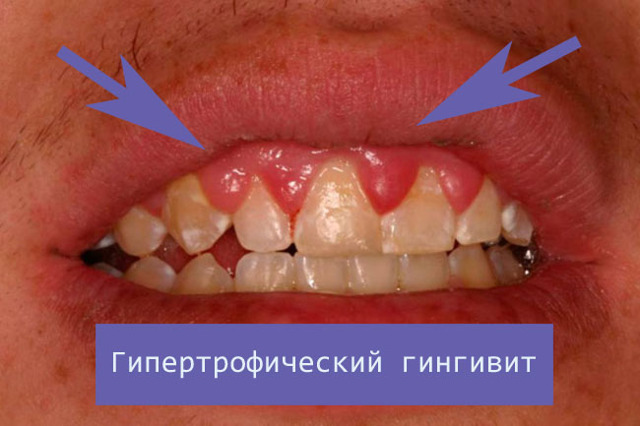 Гипертрофический гингивит
