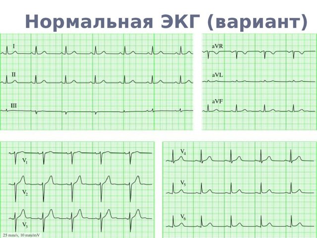 Расшифровка ЭКГ — норма и отклонения, выявление патологий