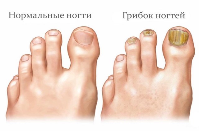 Чем лечится в домашних условиях грибок ногтей на ногах и руках
