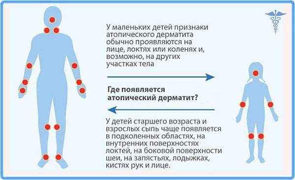 Аллергия у детей — виды, симптомы, что делать, чем лечить