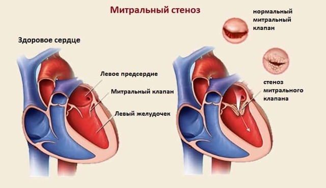 Приобретенный порок сердца
