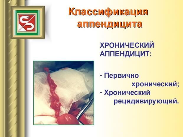 Хронический аппендицит у женщин и мужчин – симптомы, диагностика, лечение