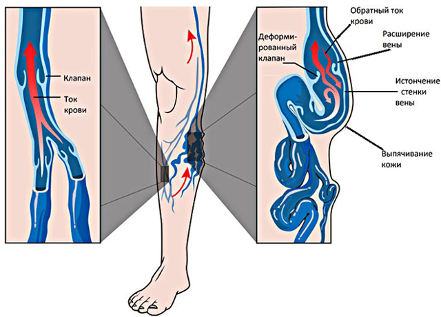 Венотоники при варикозе ног - гель, уколы, отзывы