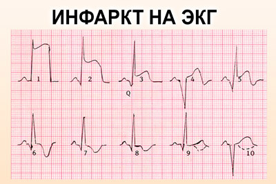 Крупноочаговый инфаркт миокарда
