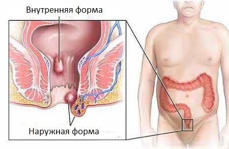 Удаление геморроя – современные операции