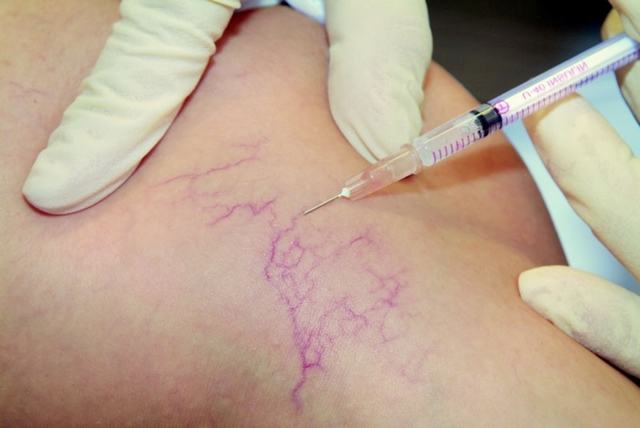 Отеки при варикозе - снимаем быстро и надолго