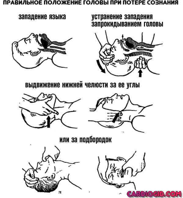 Асистолия сердца - что это такое, симптомы