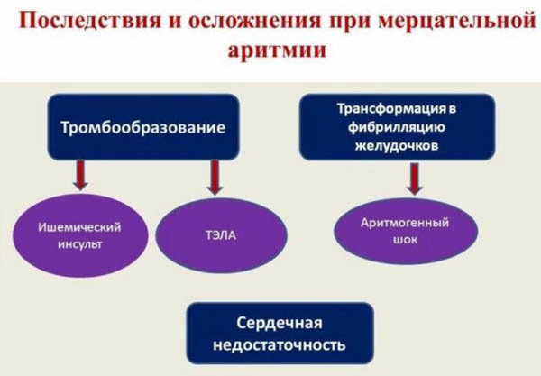 Картинки ЭКГ при нарушениях ритма