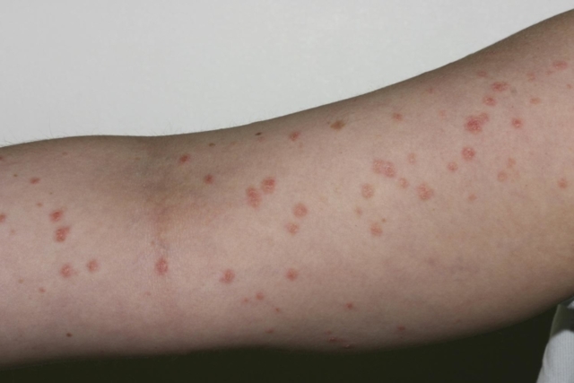 Лечение псориаз на руках - фото, симптомы, виды псориаза на руках