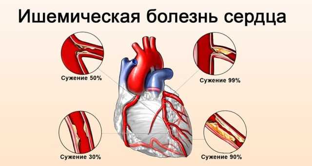 Ишемическая болезнь сердца - причины, симптомы, лечение
