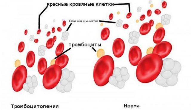 Причины и лечение тромбоцитопении у детей
