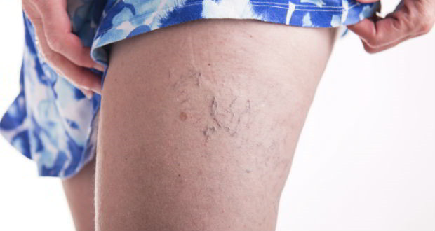 Тромб в ноге – причины, симптомы и лечение