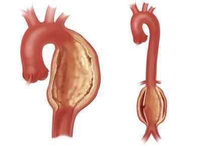 Уплотнение аорты – причины, симптомы, осложнения и лечение уплотнения аорты