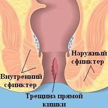 Трещина прямой кишки - симптомы, лечение