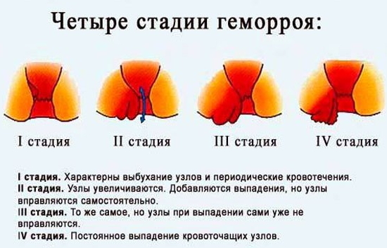 Геморрой при беременности - признаки, симптомы, причины и лечение