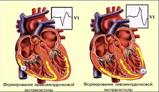 Экстрасистолы и их лечение