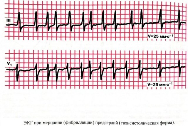 Мерцательная аритмия: причины, симптомы и лечение