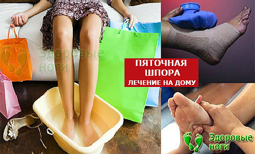 Пяточная шпора - симптомы и лечение в домашних условиях эффективными способами