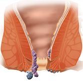 Как вылечить геморрой навсегда? Геморрой: отзывы, лечение, стоимость операции