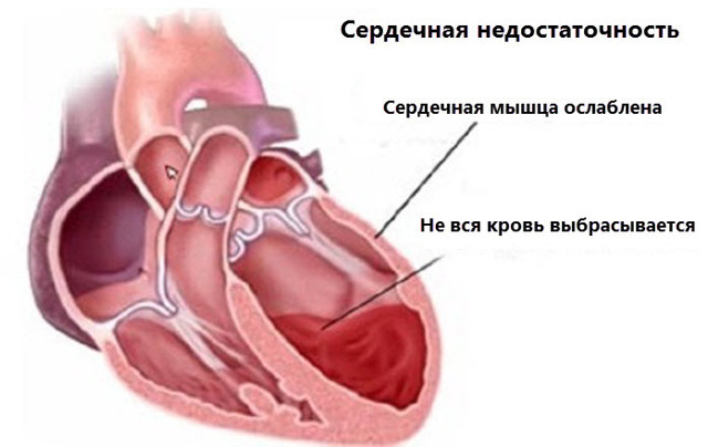 Синдром острой левожелудочковой недостаточности: первая помощь и лечение