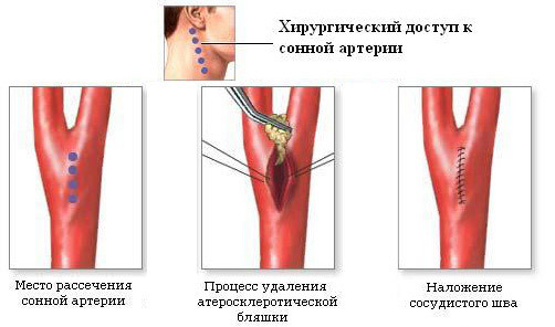 Операция на сонной артерии при атеросклерозе