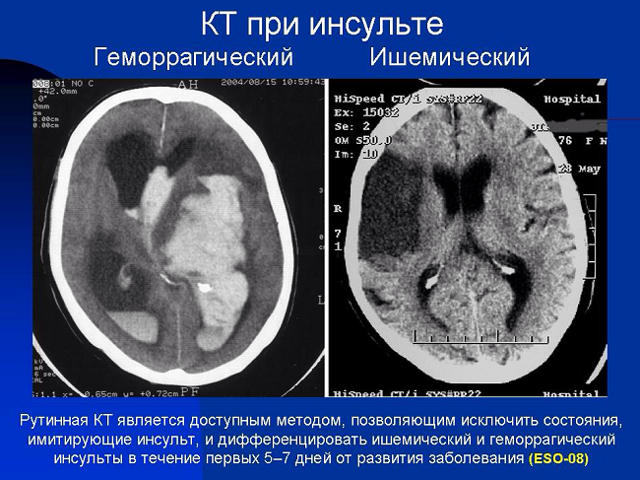 Чем отличается инфаркт миокарда от инсульта головного мозга