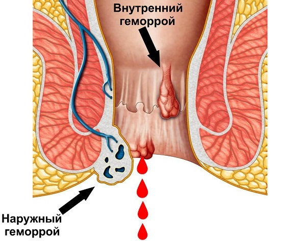 Геморрой что делать если вылез и болит, кровоточит - лечение у мужчин и женщин
