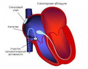 Синдром укороченного PQ: причины, симптомы, лечение