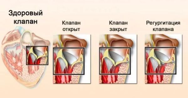 Пролапс митрального клапана с регургитацией 2 степени