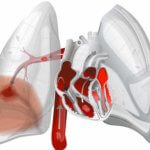 Тромб в сонной артерии: лечение, симптомы и удаление