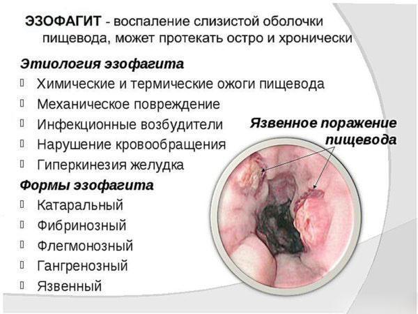 Болит посередине грудной клетки: причины, лечение, диагностика.