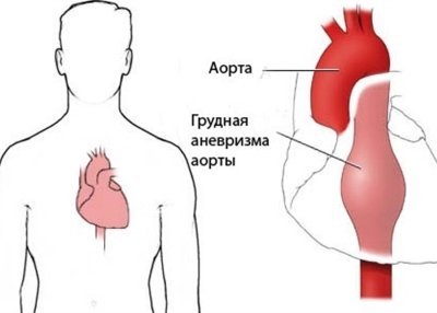 Аневризма грудного отдела аорты: диагностика и лечение