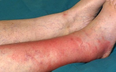 Рожа на ноге фото начальная стадия: Как начинается? - BadAcne
