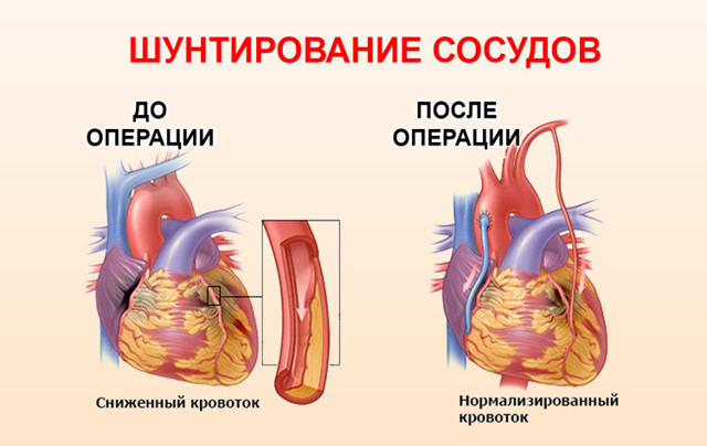 Крупноочаговый инфаркт миокарда