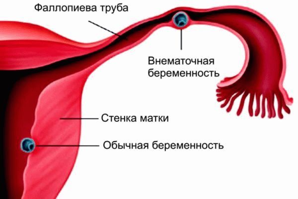 Коричневые выделения при беременности на ранних сроках: светло, темно коричневые в первом триместре на 3-5, 6-12 неделях