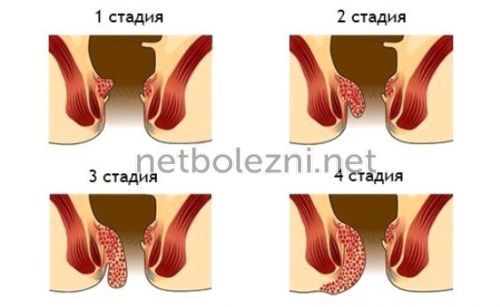 Свечи от геморроя - недорогие и эффективные свечи от геморроя при шишках