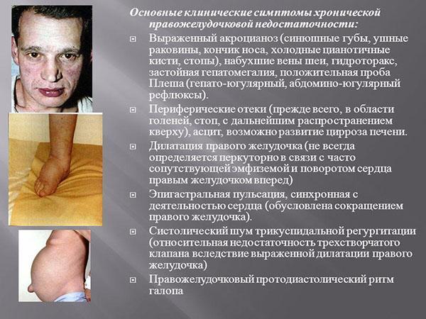 Сердечная недостаточность 2 а
