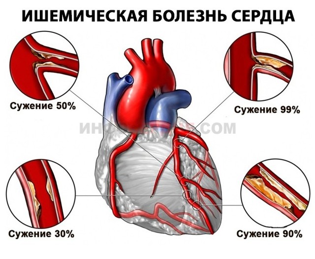 Неполная блокада левой ножки пучка Гиса - причины, лечение
