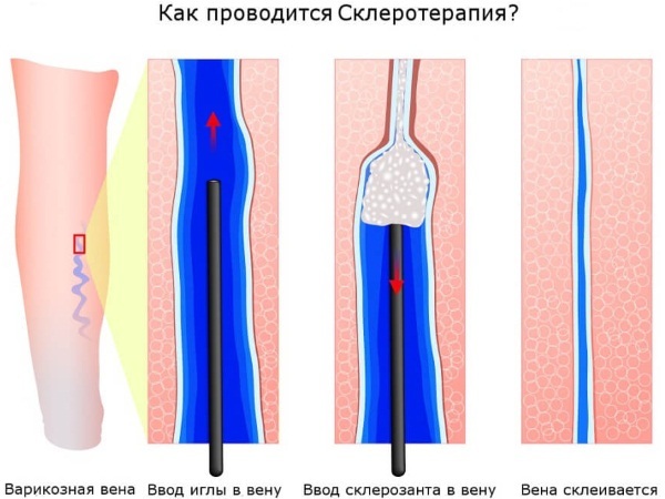 Лопнувшие капилляры на ногах: фото, как лечить и убрать, что делать? Лопаются капилляры на теле причины
