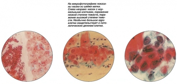 Онкоцитология шейки матки - мазок на онкоцитологию. Цитограмма воспаления с расшифровкой