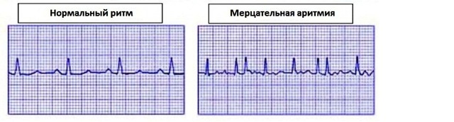 Расшифровка ЭКГ — норма и отклонения, выявление патологий