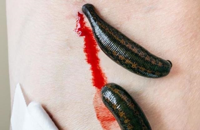 Как остановить кровь после пиявок и что означают сгустки крови после пиявок