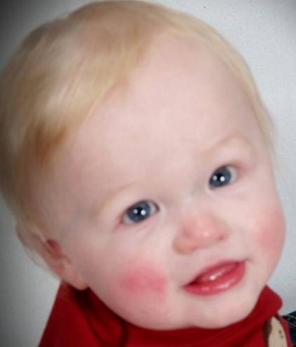 Эозинофилы в крови у ребенка: причины, симптомы, диагностика