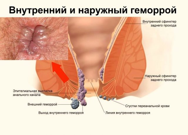 Глицериновые свечи после родов со швами. Применение глицериновых свеч после родов